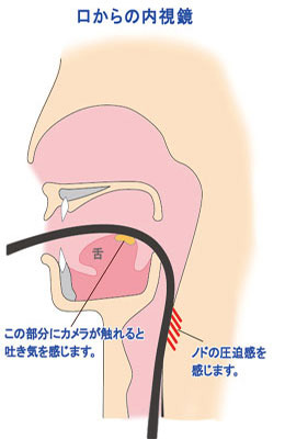 ▲口からの内視鏡