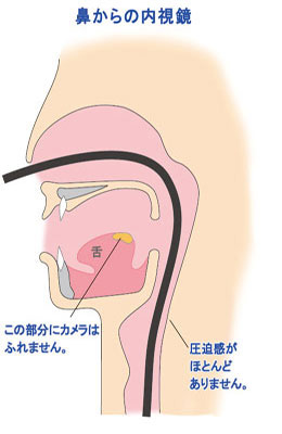 ▲鼻からの内視鏡